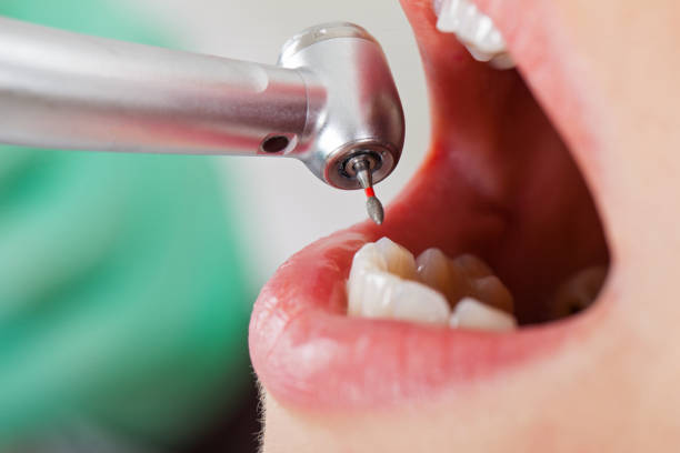 Best Emergency Root Canal Treatment in Washington, IL